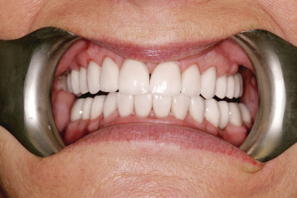 Higienizacja jamy ustnej Fluoryzacja Scaling ochota
